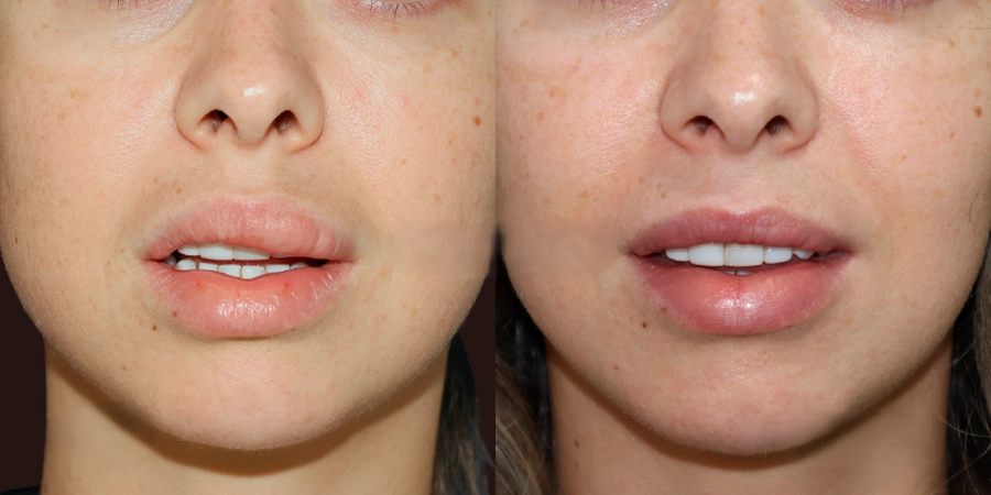 Cosmetic Lip Surgery (Cheiloplasty)