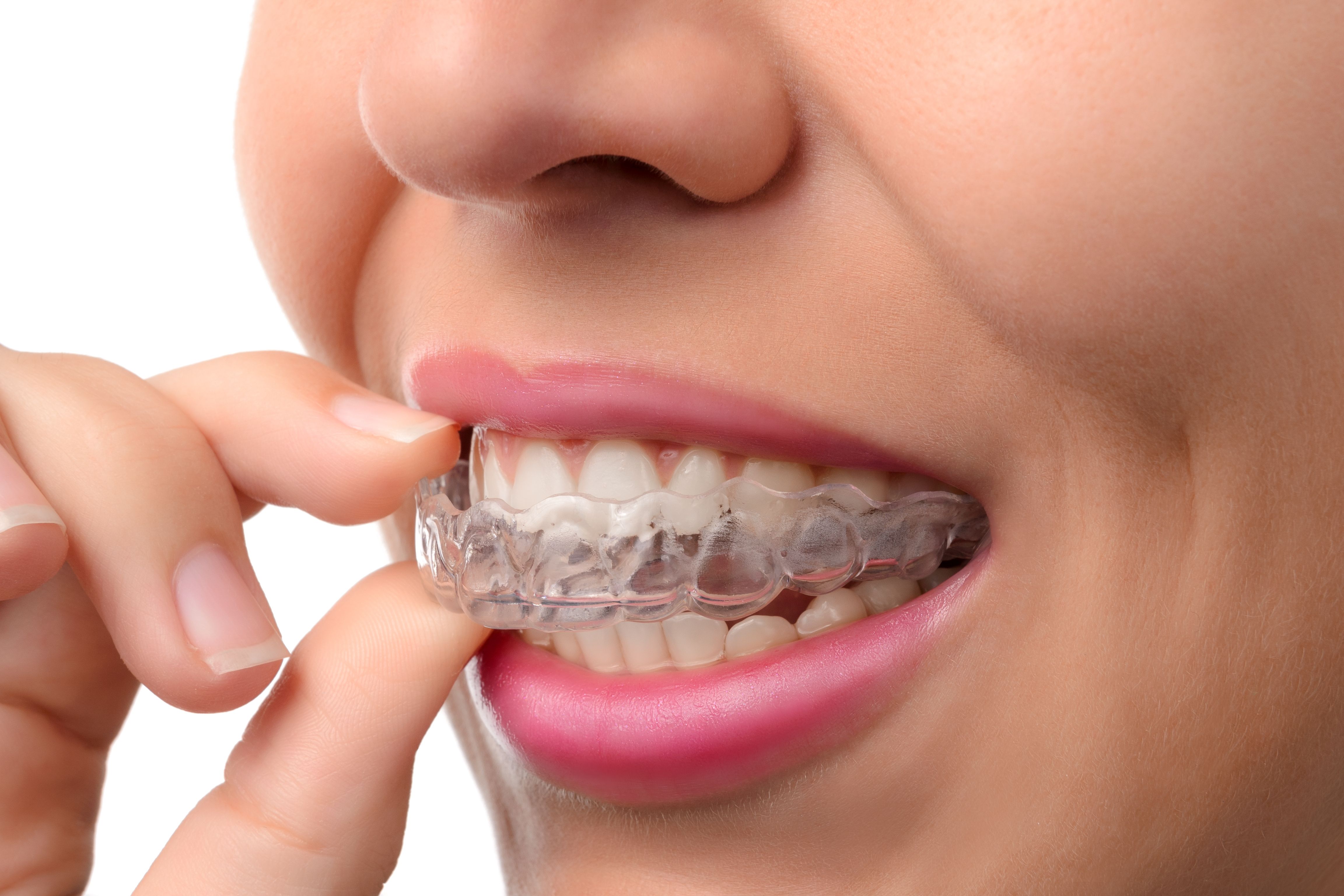 Sure Smile Aligners