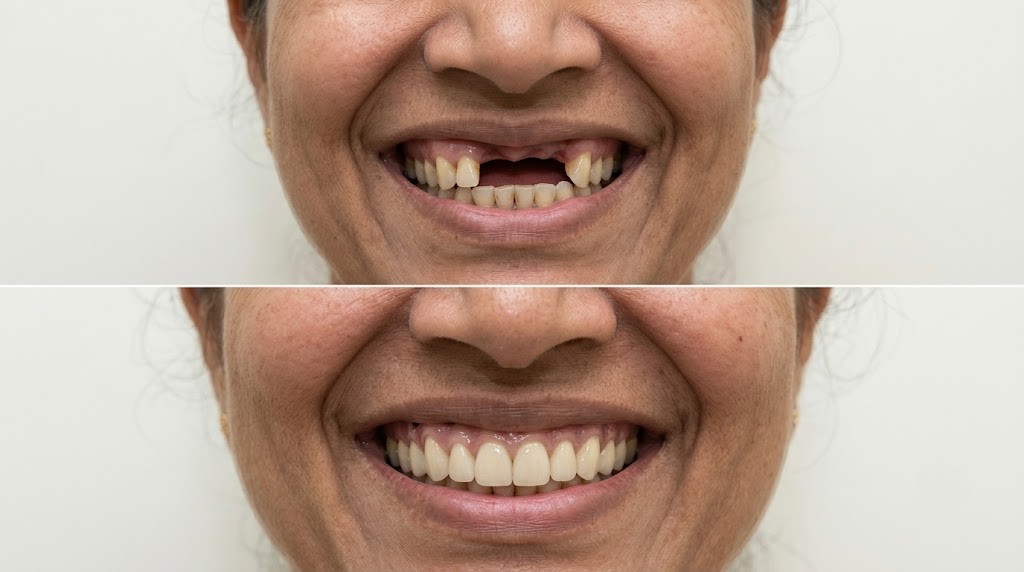 Zygoma Implants